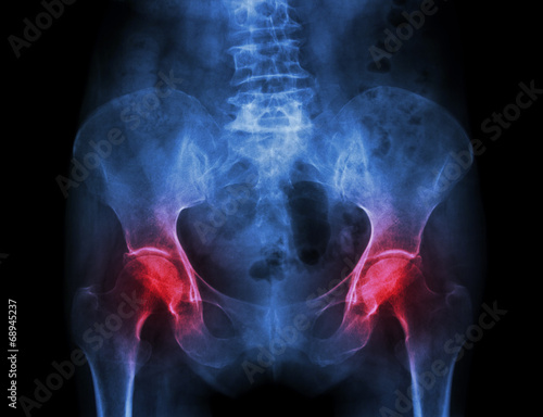 x-ray pelvis of osteoporosis patient and arthritis both hip