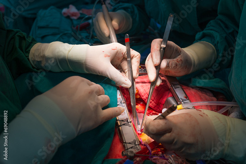 coronary artery bypass grafting photo