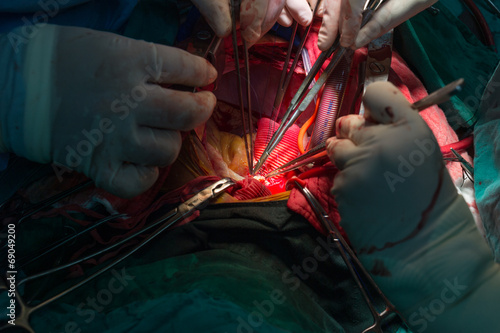 Bentall's operation in ascending aortic aneurysm photo