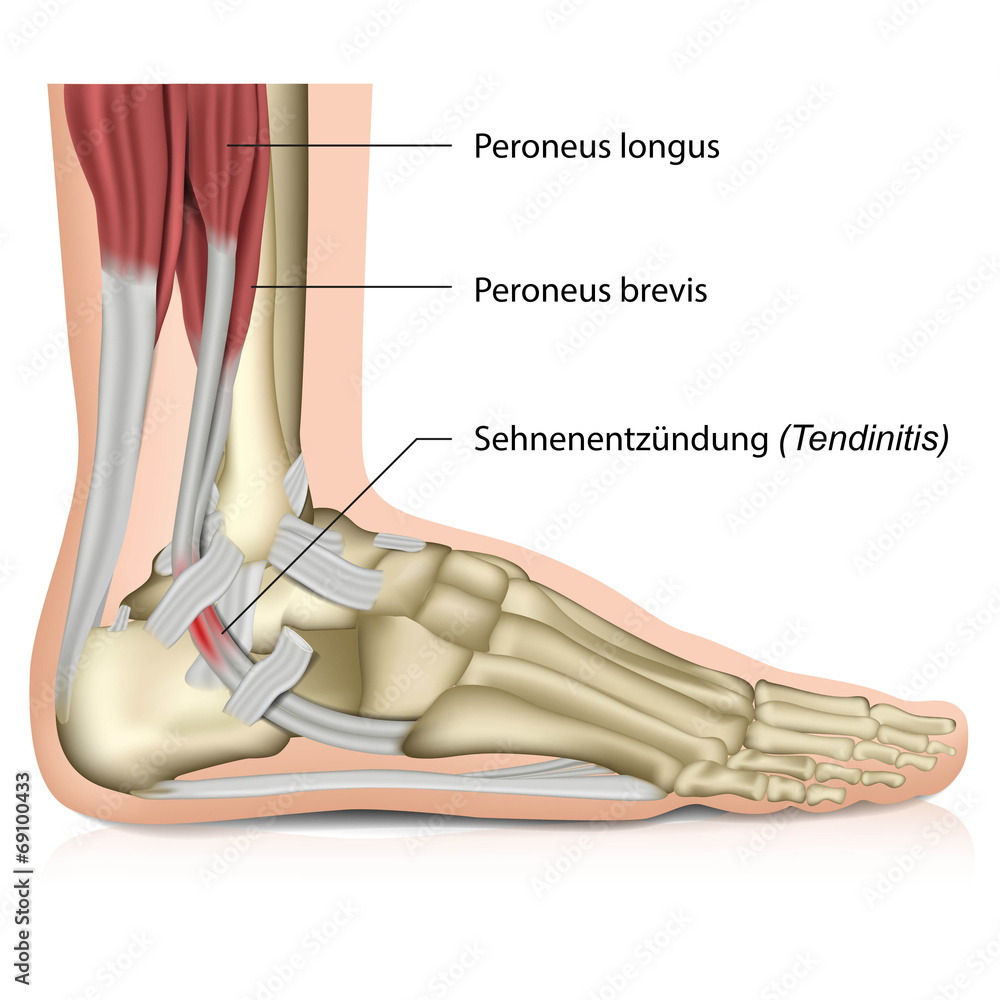 Sehnenscheidenentzündung am Fuß Stock-Vektorgrafik | Adobe Stock