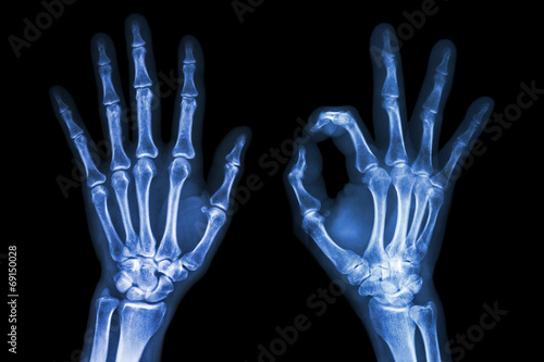 X-ray both hands with OK sign