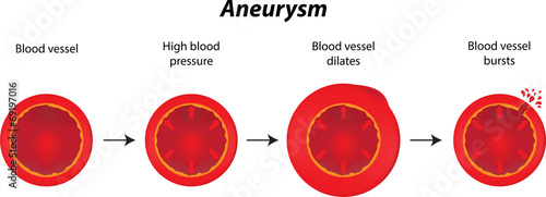Aneurysm