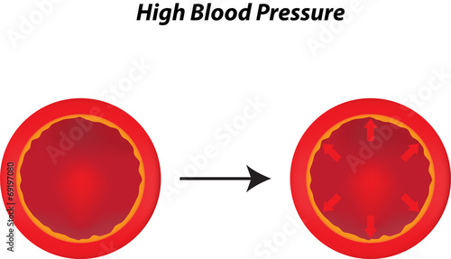 High Blood Pressure photo