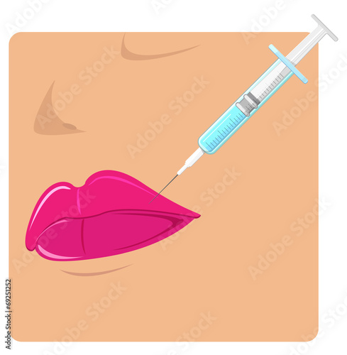 Botox Injection - Illustration