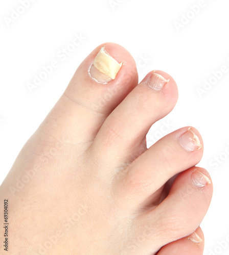 Photography reconstruction nail