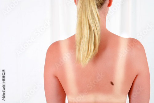 Hautkrebs - Gefahr durch Sonnenbrand