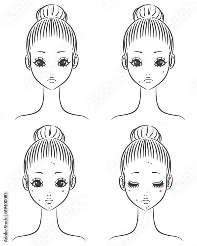 ニキビ　女性