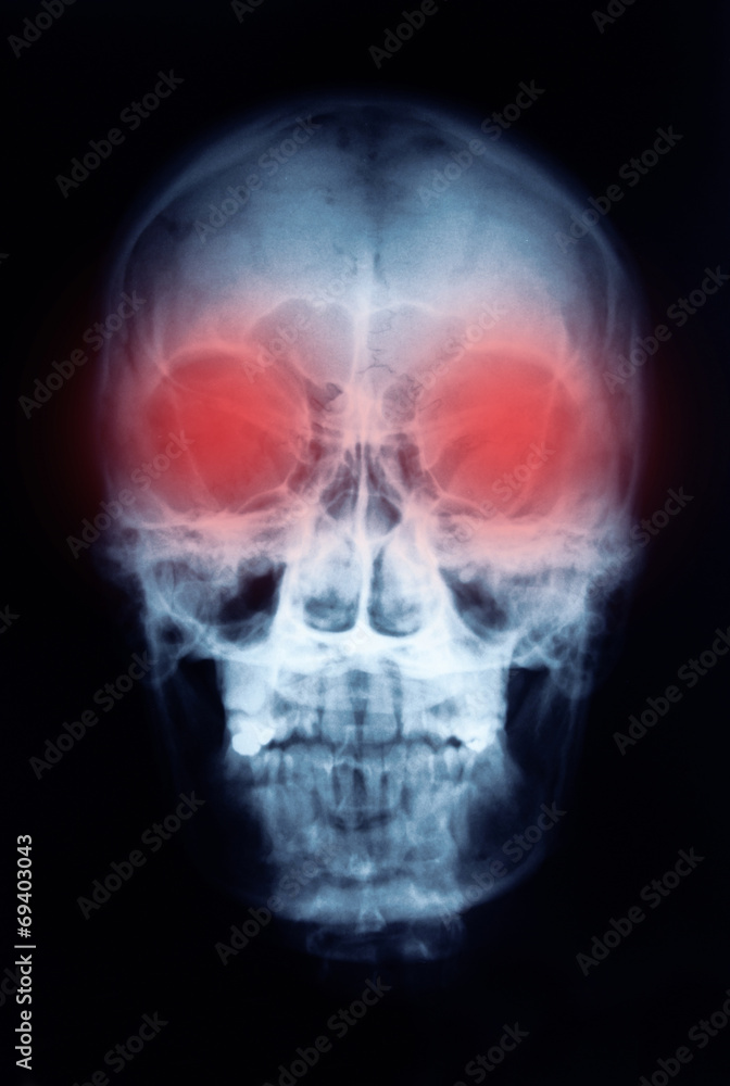 X-ray picture of the skull X-ray picture of the skull