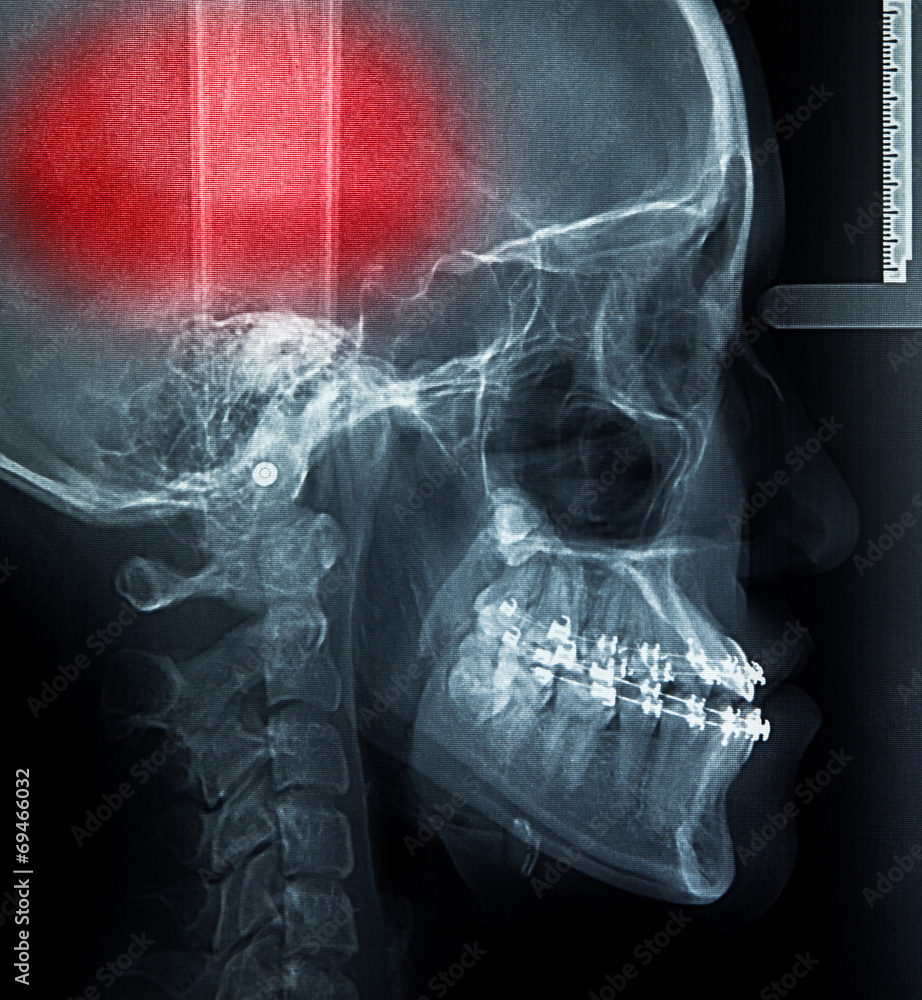 X-Ray scan human