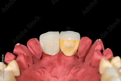 Fototapeta Naklejka Na Ścianę i Meble -  Dental ceramic crowns