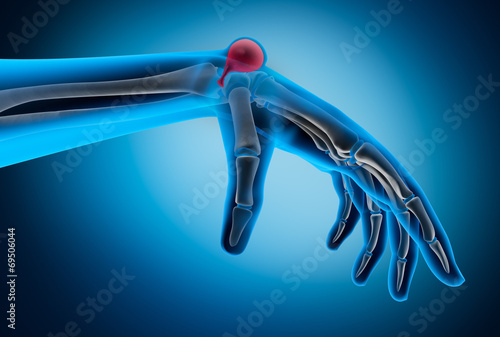 Ganglion an Handgelenk 2