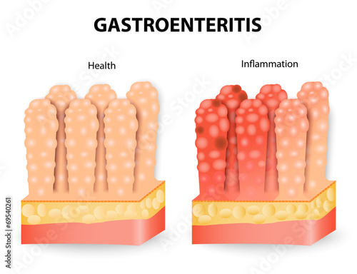 Gastroenteritis or infectious diarrhea