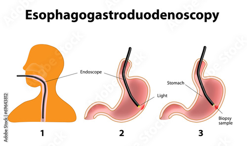 Esophagogastroduodenoscopy or oesophagogastroduodenoscopy or pan