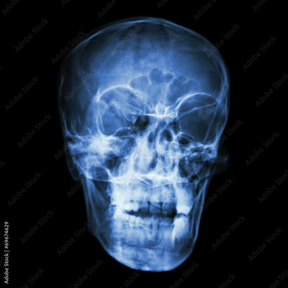 asian people's skull (Thai people) asian people's skull (Thai people)
