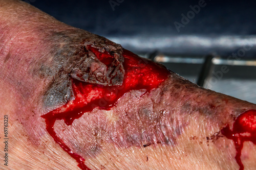 macro shot of a skin scratch with red blood photo