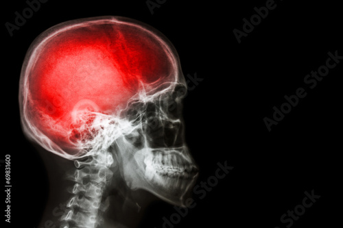X-ray skull & cervical spine (lateral) with "Stroke"