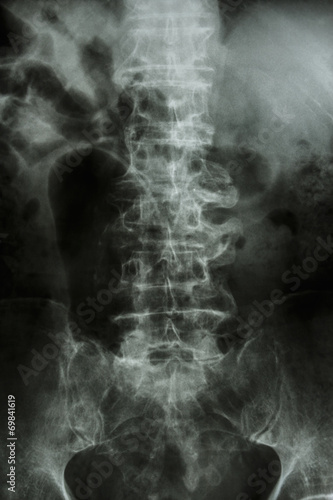 "Spondylosis"  lumbar spine with spur & collapse