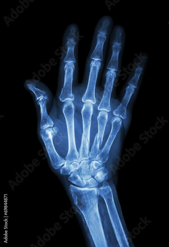 Multiple fracture at index,little finger,metacarpal bone © stockdevil