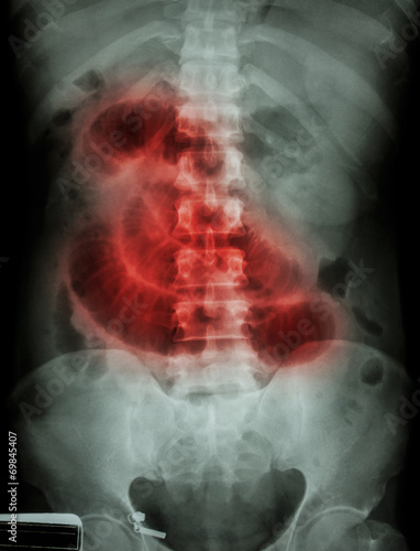 "Small intestine obstruction" Film X-ray abdomen supine