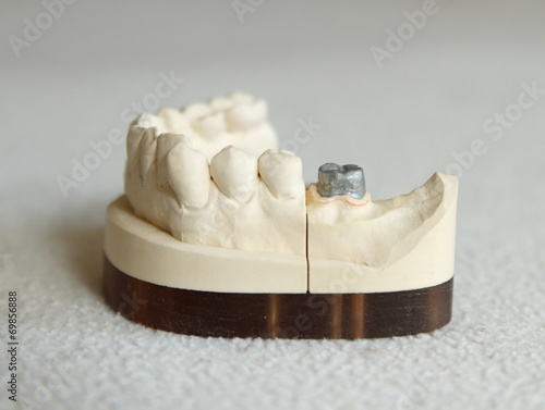 Zirconium or porcelain crown preparation
