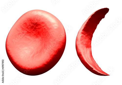 Normal vs Sickle Red Blood Cell