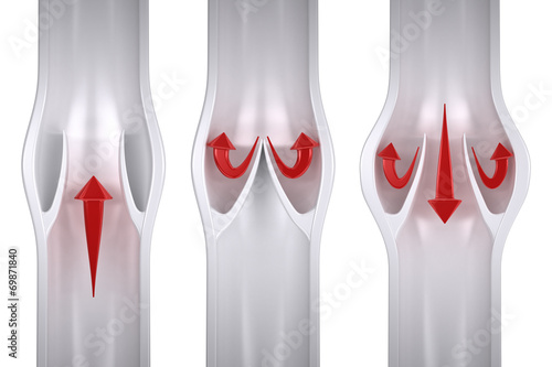 Normal vs Varicose - Vein Anatomy