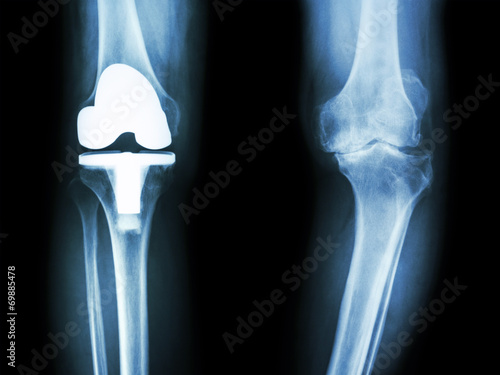 osteoarthritis knee patient and artificial joint photo