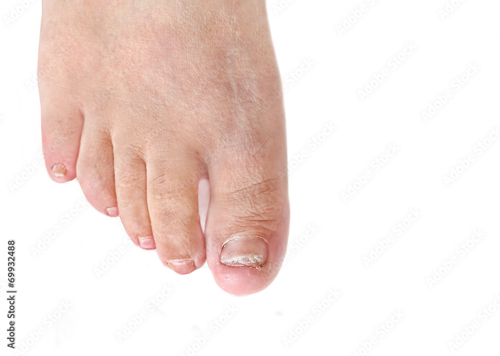 Toenail fungus infection dermatophytic onychomycosis StockFoto