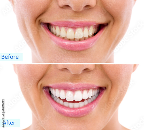 Fototapeta Naklejka Na Ścianę i Meble -  whitening - bleaching treatment ,woman teeth and smile, before a