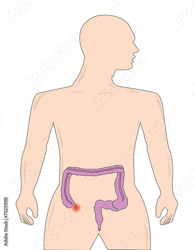 appendicitis