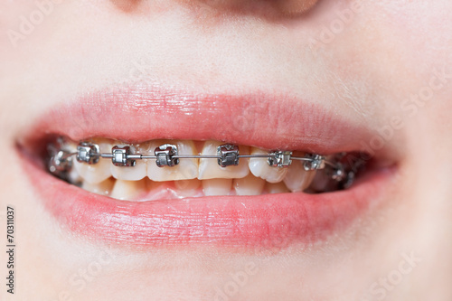 front view of dental braces on teeth of upper jaw