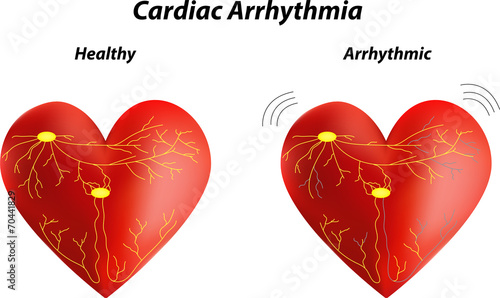 Cardiac Arrhythmia