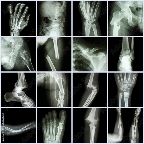 Collection X-ray multiple bone fracture