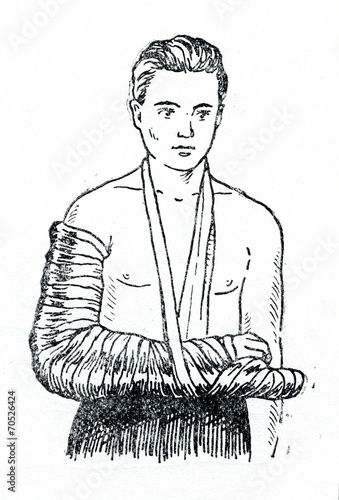 Obraz na plátně Emergency splinting of forearm fracture