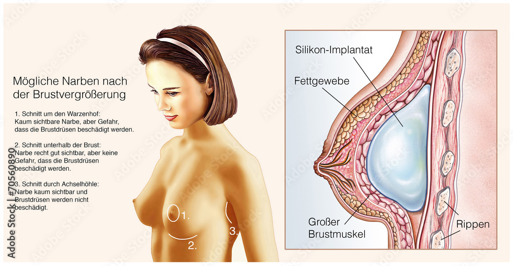 Silikon-Implantat.Brustvergrößerung Stock Illustration