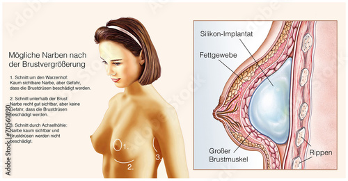 Silikon-Implantat.Brustvergrößerung photo