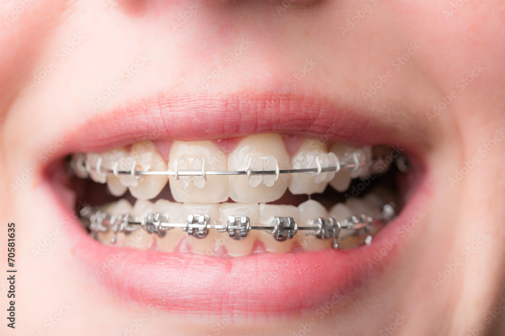 Fototapeta premium Zahnspange