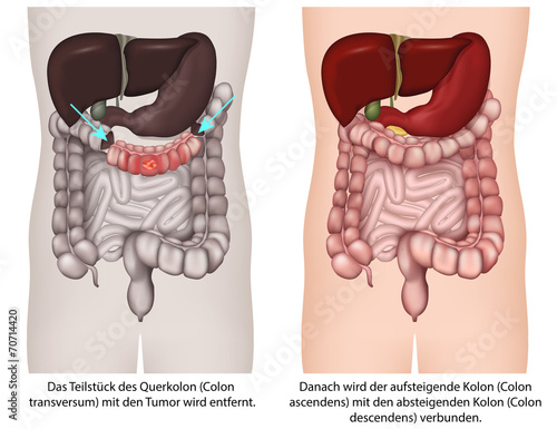 Transversumresektion, transverse colectomy, illustration
