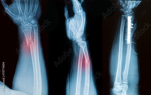 Tablou canvas x-ray image of borken forearm bone show pre- post operation