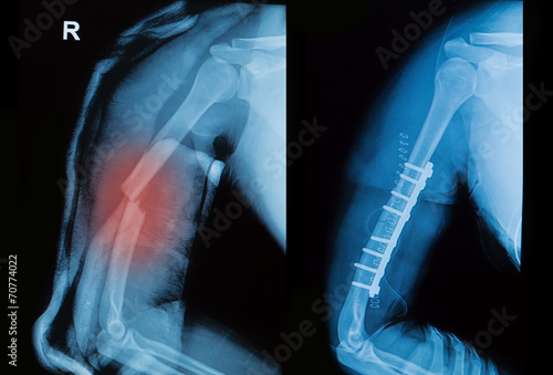 Photo x-ray image of borken arm bone show pre- post operation