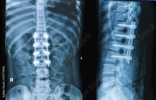 x-ray image of back pain show spinal column with implant fusion photo