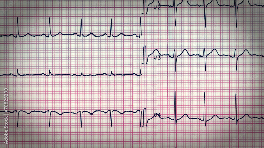 Retro look Electrocardiography of heart beat Retro look Electrocardiography of heart beat