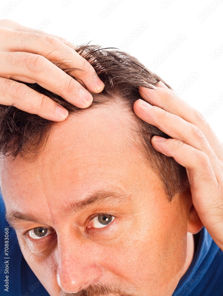 Fototapeta premium Androgenic Hair Loss