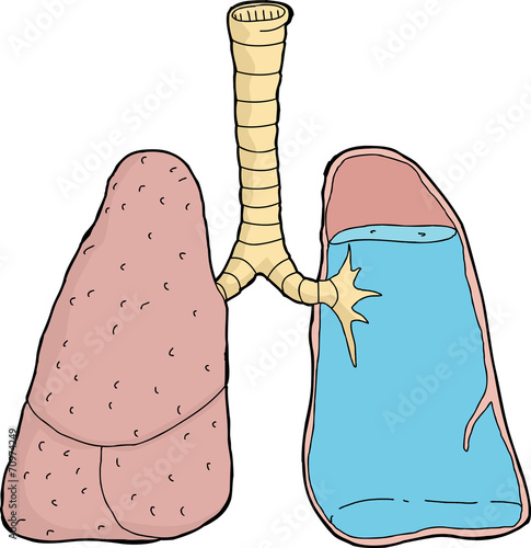 Water In Lungs