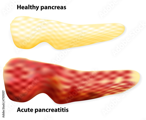 Pancreatitis. The differences between healthy pancreas and infla