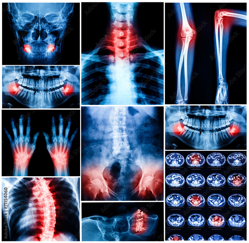 Collage of human X-rays photo