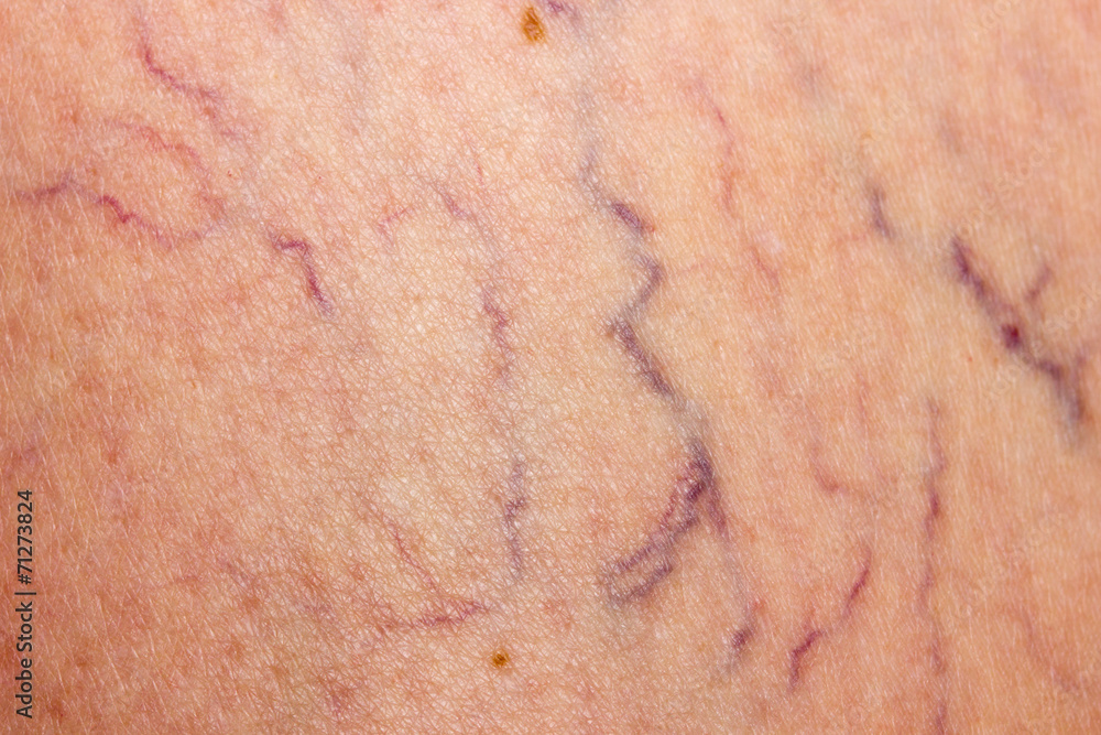 Fototapeta premium Affected by varicose veins