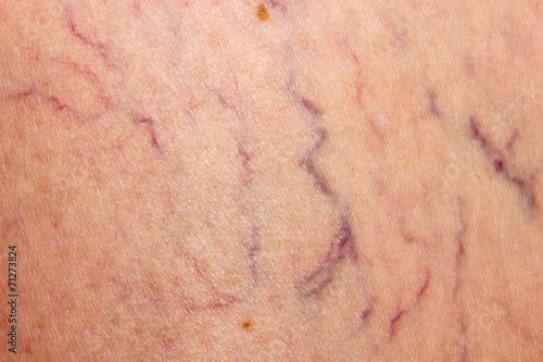 Affected by varicose veins photo