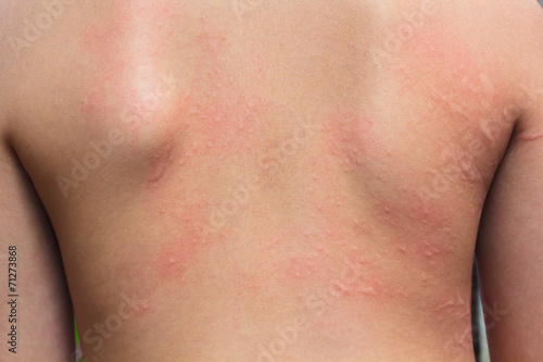 Allergic rash.