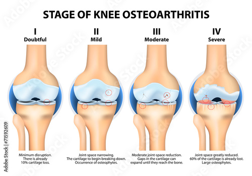 Stages of knee Osteoarthritis (OA). photo